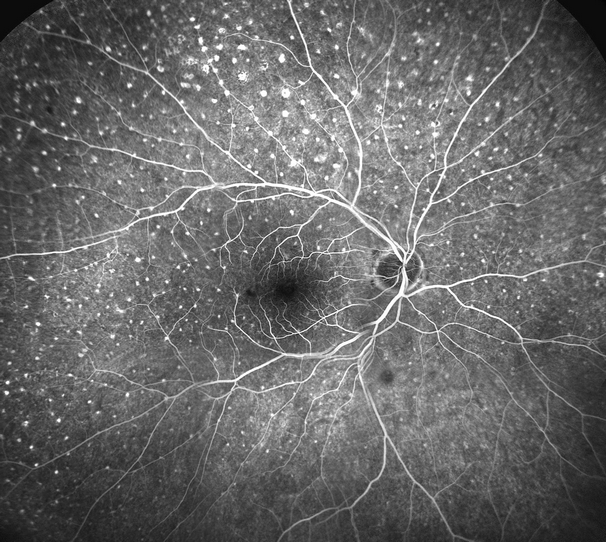 angiographie fluo panoramique d'un oeil